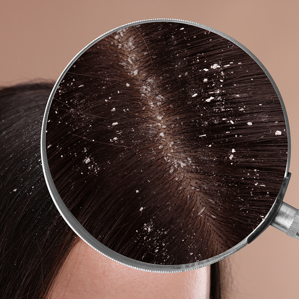 Lucovitaal Shampoo schilfer 200ml